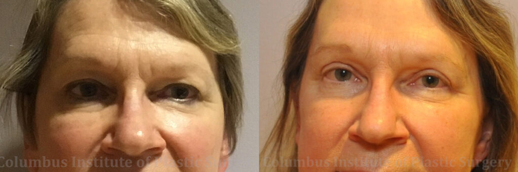Blepharoplasty before and after photo by Columbus Institute of Plastic Surgery in Columbus, OH