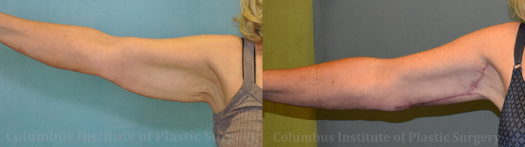 Brachioplasty (Arm Lift) before and after photo by Columbus Institute of Plastic Surgery in Columbus, OH