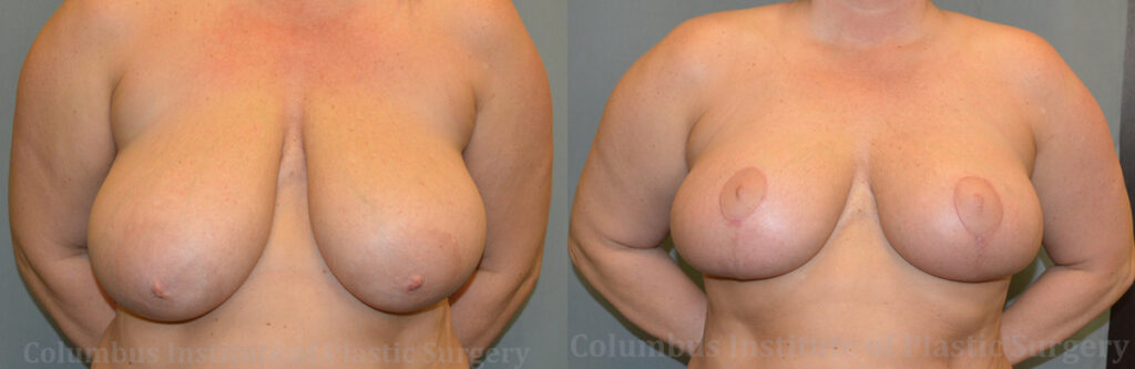 Breast Reduction before and after photo by Columbus Institute of Plastic Surgery in Columbus, OH