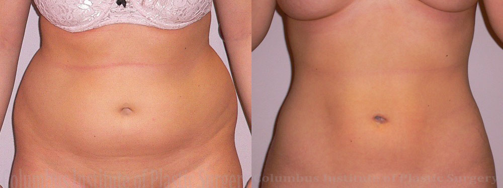 Liposuction before and after photo by Columbus Institute of Plastic Surgery in Columbus, OH