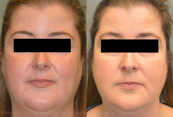 TCA Chemical Peel before and after photo by Columbus Institute of Plastic Surgery in Columbus, OH