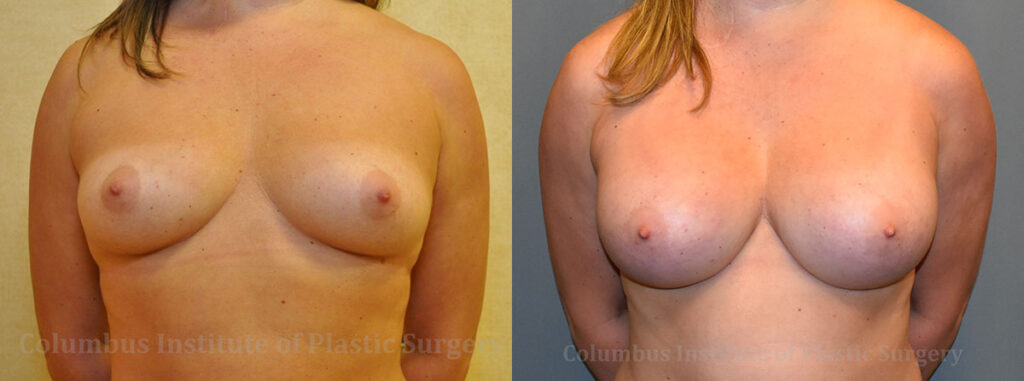 Breast Augmentation before and after photo by Columbus Institute of Plastic Surgery in Columbus, OH