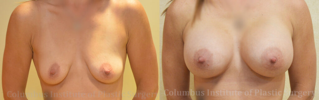 Breast Augmentation – 500cc-600cc before and after photo by Columbus Institute of Plastic Surgery in Columbus, OH