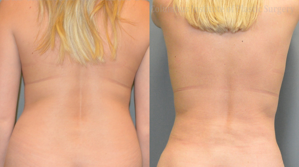 Liposuction before and after photo by Columbus Institute of Plastic Surgery in Columbus, OH