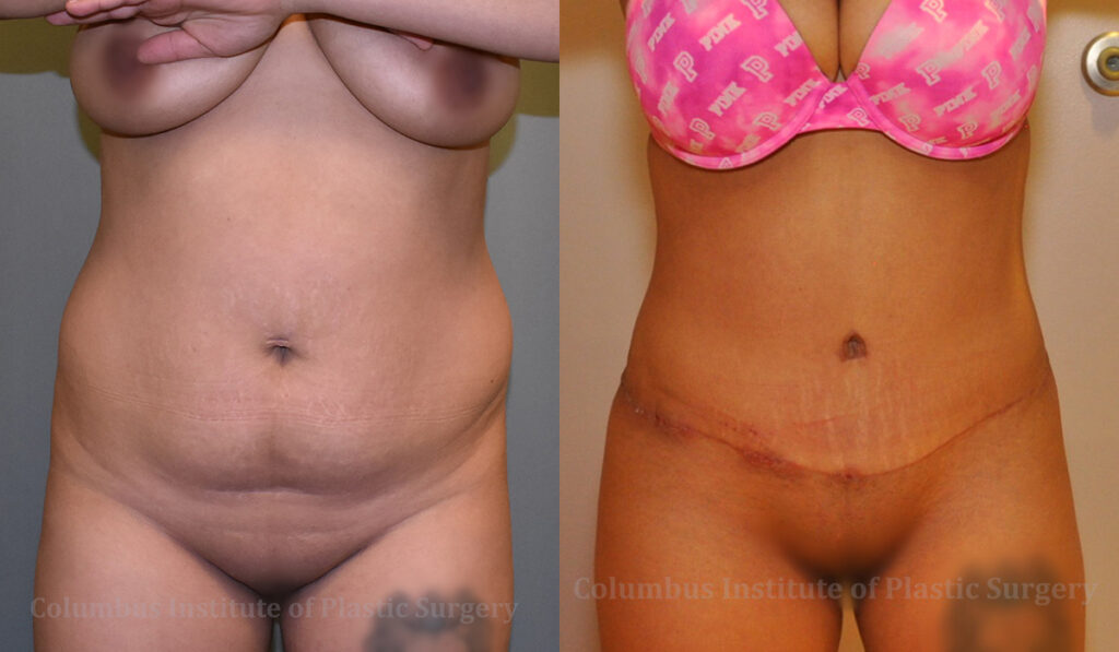 Abdominoplasty (Tummy Tuck) before and after photo by Columbus Institute of Plastic Surgery in Columbus, OH