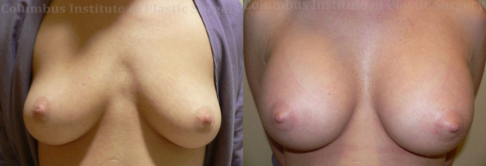 Breast Augmentation – 400cc-500cc before and after photo by Columbus Institute of Plastic Surgery in Columbus, OH
