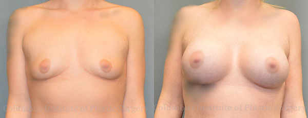 Breast Augmentation – 500cc-600cc before and after photo by Columbus Institute of Plastic Surgery in Columbus, OH