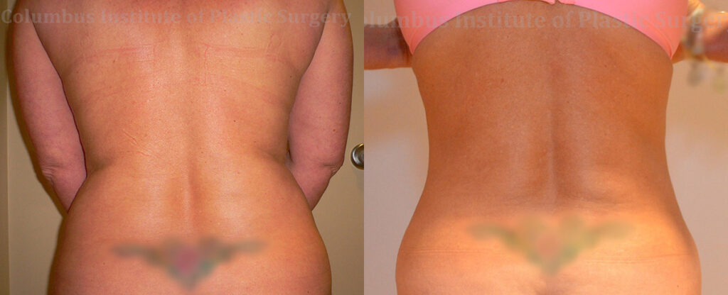 Liposuction before and after photo by Columbus Institute of Plastic Surgery in Columbus, OH