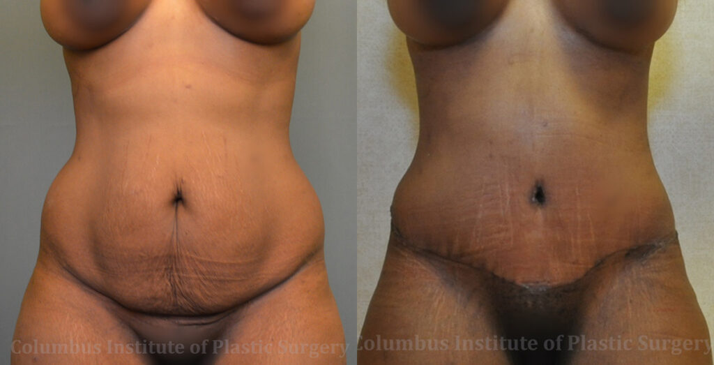 Abdominoplasty (Tummy Tuck) before and after photo by Columbus Institute of Plastic Surgery in Columbus, OH