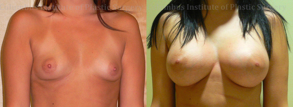 Breast Augmentation – 500cc-600cc before and after photo by Columbus Institute of Plastic Surgery in Columbus, OH