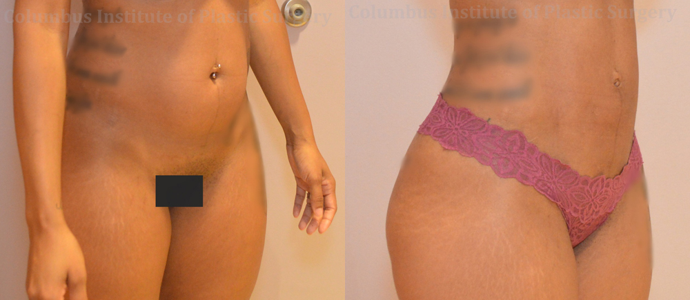 Liposuction before and after photo by Columbus Institute of Plastic Surgery in Columbus, OH