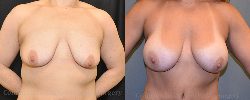 Breast Augmentation – 600cc-700cc before and after photo by Columbus Institute of Plastic Surgery in Columbus, OH
