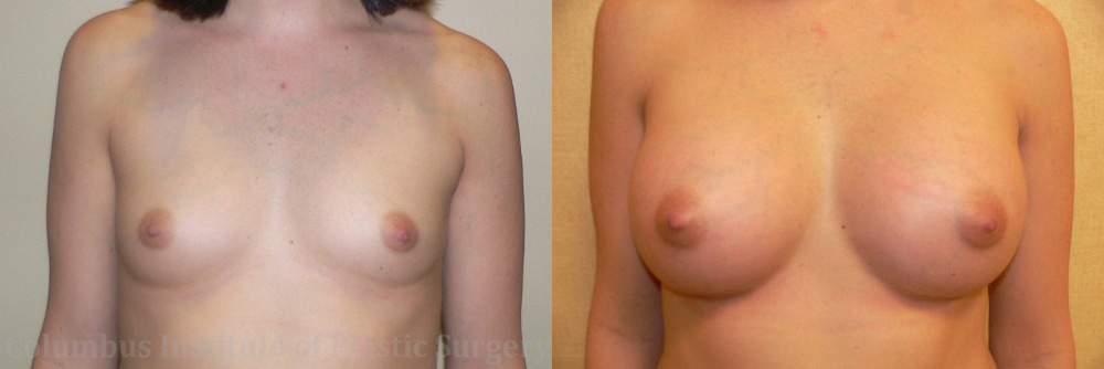 Breast Augmentation – 400cc-500cc before and after photo by Columbus Institute of Plastic Surgery in Columbus, OH