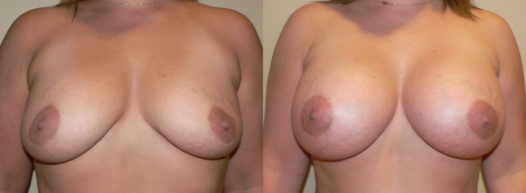 Breast Augmentation – 500cc-600cc before and after photo by Columbus Institute of Plastic Surgery in Columbus, OH