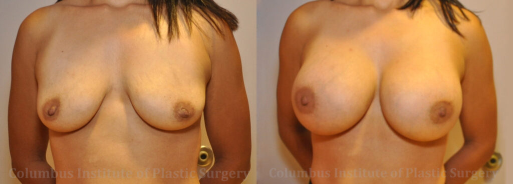 Breast Augmentation – 600cc-700cc before and after photo by Columbus Institute of Plastic Surgery in Columbus, OH