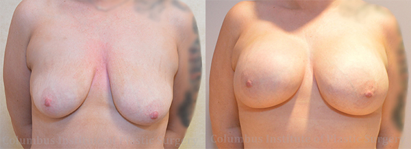 Breast Augmentation – 600cc-700cc before and after photo by Columbus Institute of Plastic Surgery in Columbus, OH