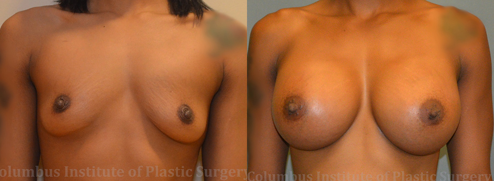Breast Augmentation – 600cc-700cc before and after photo by Columbus Institute of Plastic Surgery in Columbus, OH