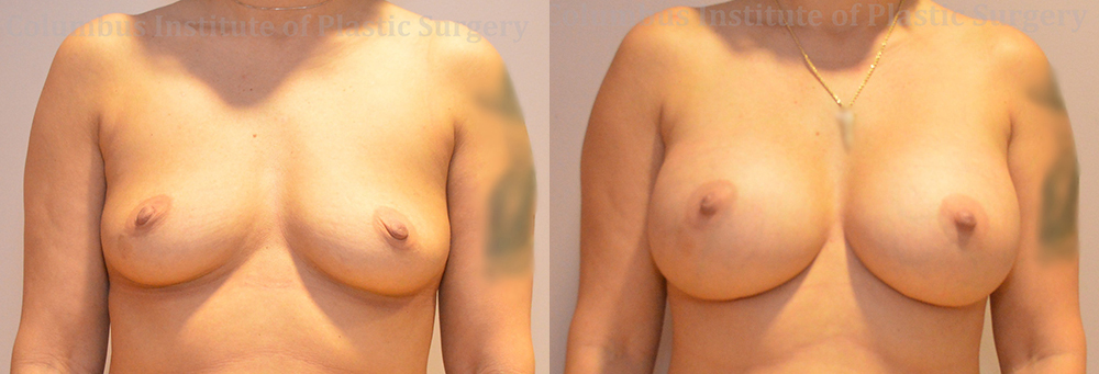 Breast Augmentation – 600cc-700cc before and after photo by Columbus Institute of Plastic Surgery in Columbus, OH