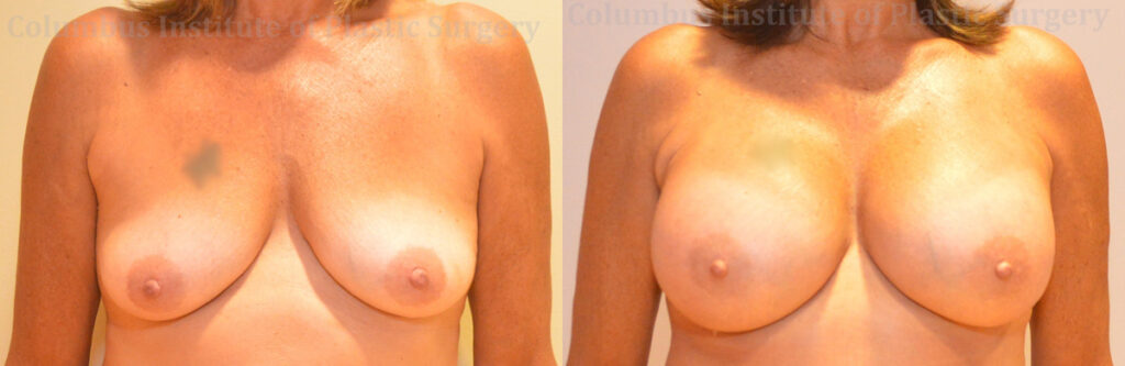 Breast Augmentation – 600cc-700cc before and after photo by Columbus Institute of Plastic Surgery in Columbus, OH