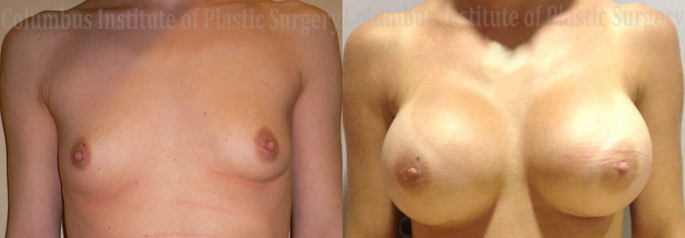 Breast Augmentation – 600cc-700cc before and after photo by Columbus Institute of Plastic Surgery in Columbus, OH