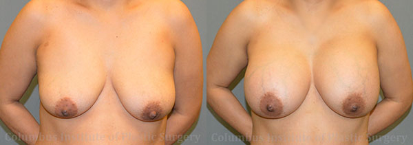 Breast Augmentation – 600cc-700cc before and after photo by Columbus Institute of Plastic Surgery in Columbus, OH