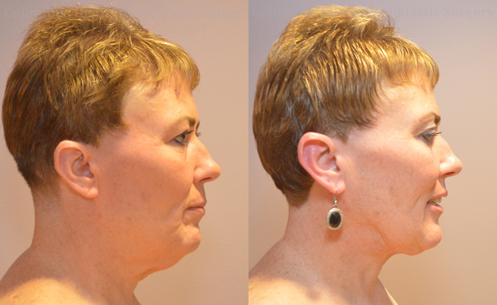 Liposuction before and after photo by Columbus Institute of Plastic Surgery in Columbus, OH