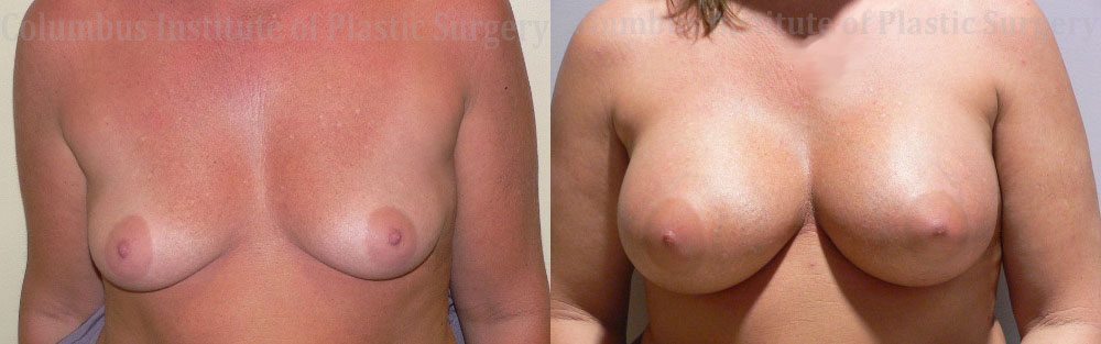 Breast Augmentation – 600cc-700cc before and after photo by Columbus Institute of Plastic Surgery in Columbus, OH