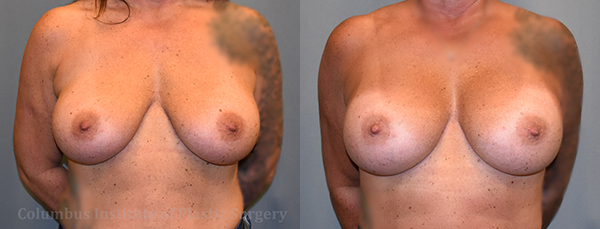 Breast Augmentation – 700cc-800cc before and after photo by Columbus Institute of Plastic Surgery in Columbus, OH