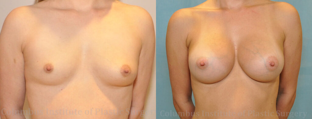 Breast Augmentation before and after photo by Columbus Institute of Plastic Surgery in Columbus, OH