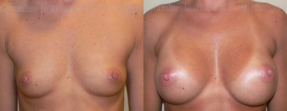 Breast Augmentation – 300cc-400cc before and after photo by Columbus Institute of Plastic Surgery in Columbus, OH
