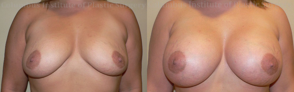 Breast Augmentation – 500cc-600cc before and after photo by Columbus Institute of Plastic Surgery in Columbus, OH