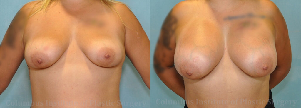 Breast Augmentation – 700cc-800cc before and after photo by Columbus Institute of Plastic Surgery in Columbus, OH