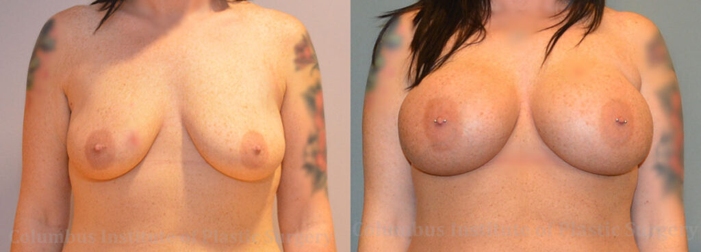 Breast Augmentation – 700cc-800cc before and after photo by Columbus Institute of Plastic Surgery in Columbus, OH