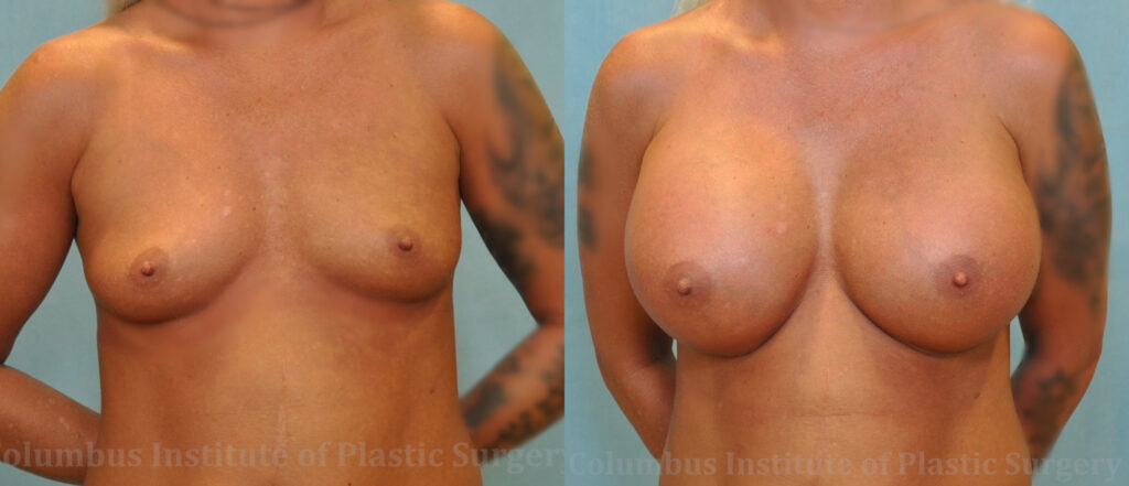 Breast Augmentation – 700cc-800cc before and after photo by Columbus Institute of Plastic Surgery in Columbus, OH
