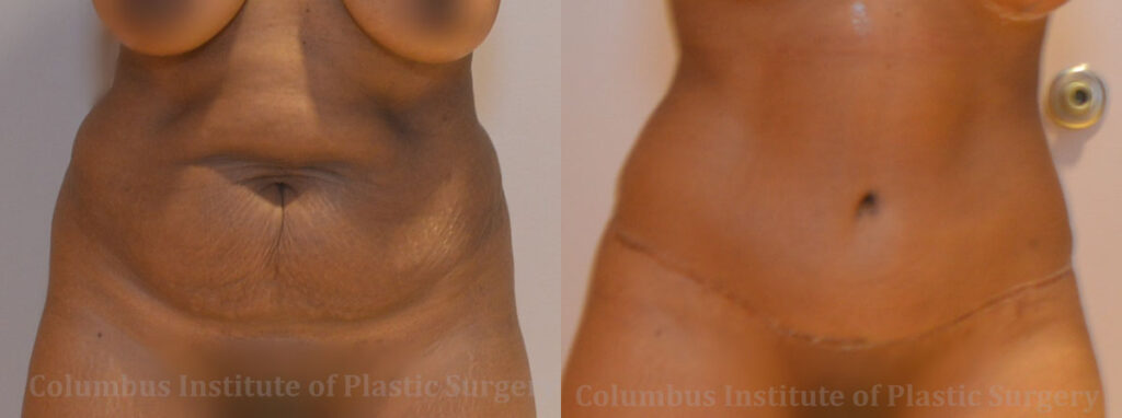 Abdominoplasty (Tummy Tuck) before and after photo by Columbus Institute of Plastic Surgery in Columbus, OH