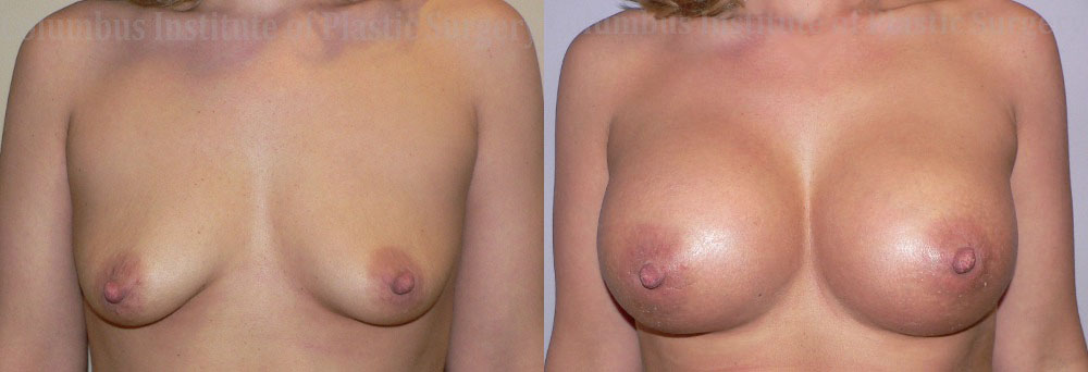 Breast Augmentation – 500cc-600cc before and after photo by Columbus Institute of Plastic Surgery in Columbus, OH