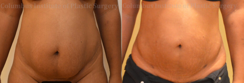 Liposuction before and after photo by Columbus Institute of Plastic Surgery in Columbus, OH