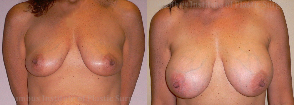 Breast Augmentation before and after photo by Columbus Institute of Plastic Surgery in Columbus, OH