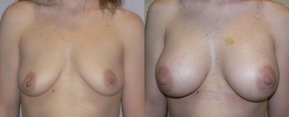 Breast Augmentation before and after photo by Columbus Institute of Plastic Surgery in Columbus, OH