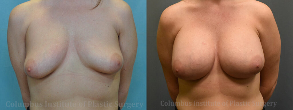 Breast Augmentation before and after photo by Columbus Institute of Plastic Surgery in Columbus, OH