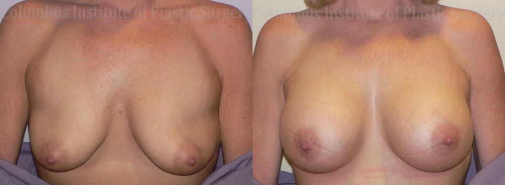 Breast Augmentation before and after photo by Columbus Institute of Plastic Surgery in Columbus, OH