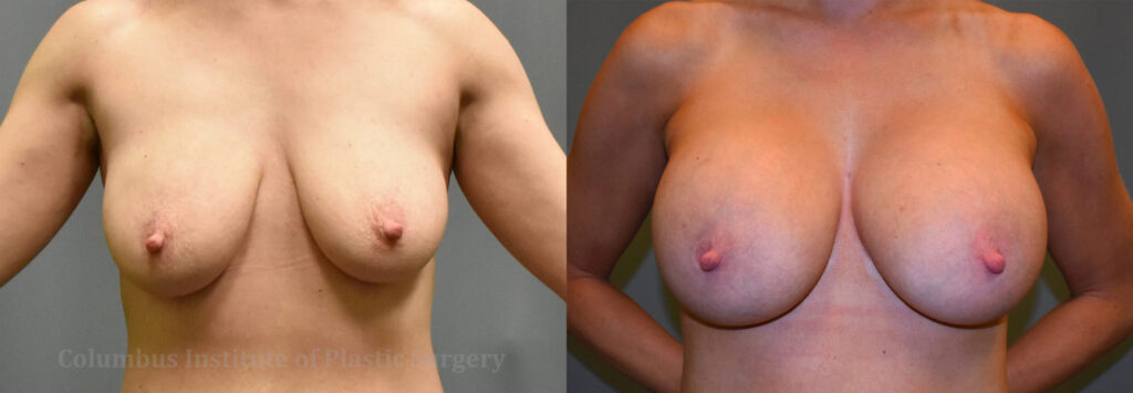 Breast Augmentation before and after photo by Columbus Institute of Plastic Surgery in Columbus, OH