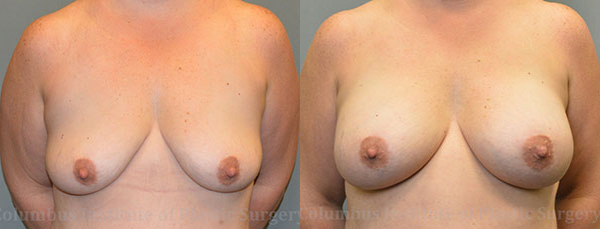 Breast Augmentation before and after photo by Columbus Institute of Plastic Surgery in Columbus, OH