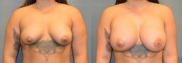 Breast Augmentation before and after photo by Columbus Institute of Plastic Surgery in Columbus, OH