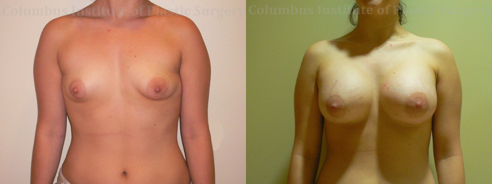 Breast Augmentation – 500cc-600cc before and after photo by Columbus Institute of Plastic Surgery in Columbus, OH