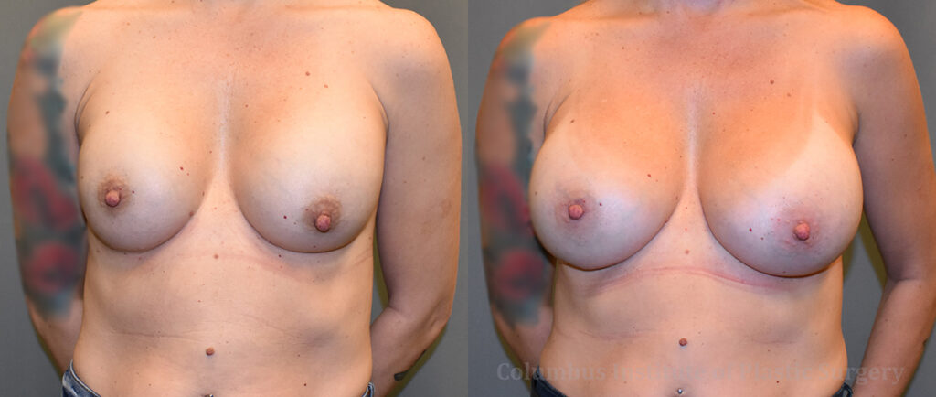 Breast Implant Exchange before and after photo by Columbus Institute of Plastic Surgery in Columbus, OH