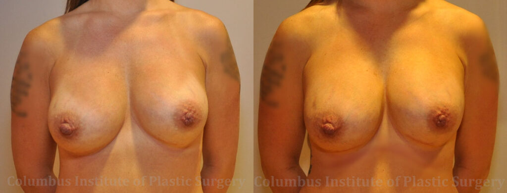 Breast Implant Exchange before and after photo by Columbus Institute of Plastic Surgery in Columbus, OH