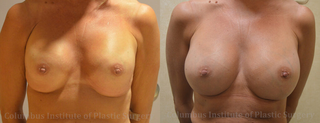 Breast Implant Exchange before and after photo by Columbus Institute of Plastic Surgery in Columbus, OH