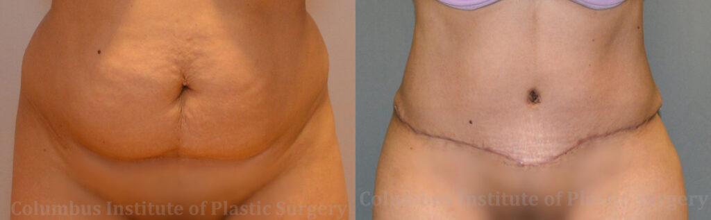 Abdominoplasty (Tummy Tuck) before and after photo by Columbus Institute of Plastic Surgery in Columbus, OH