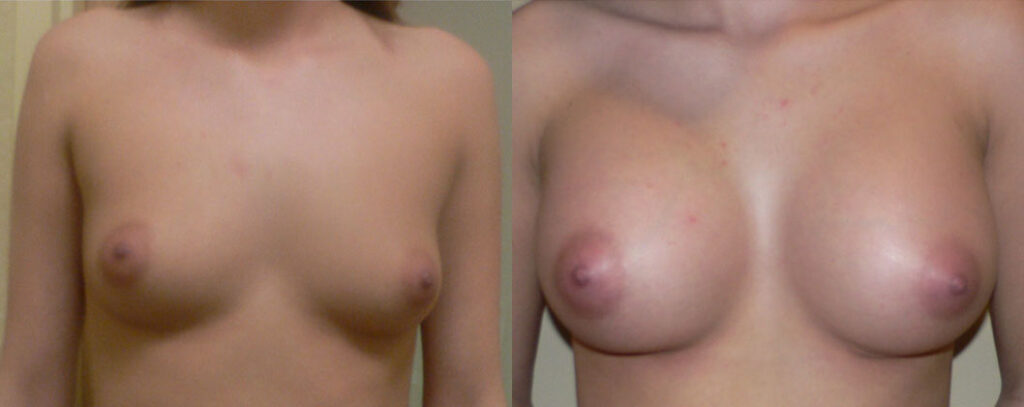 Breast Augmentation – 500cc-600cc before and after photo by Columbus Institute of Plastic Surgery in Columbus, OH